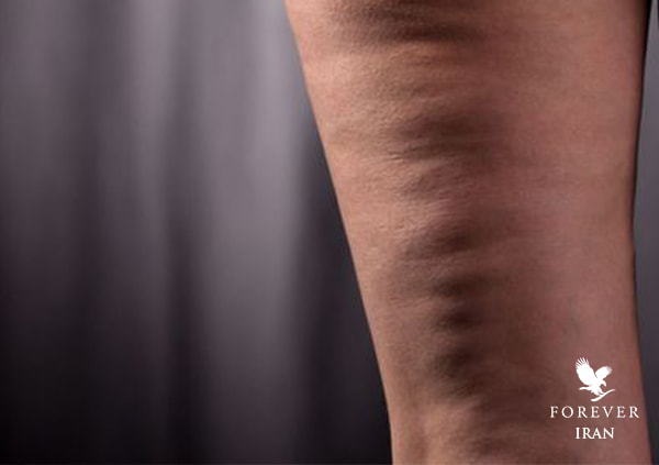 سلولیت چیست